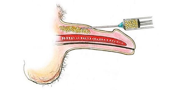 Bir üyenin namlusuna hiyalüronik asit enjeksiyonları